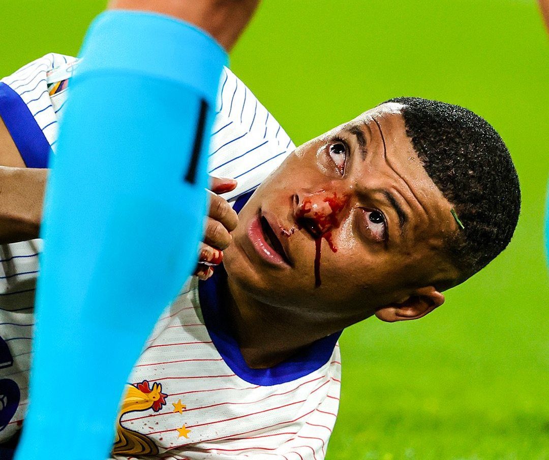 Euro 2024: Mbappe Suffers Broken Nose