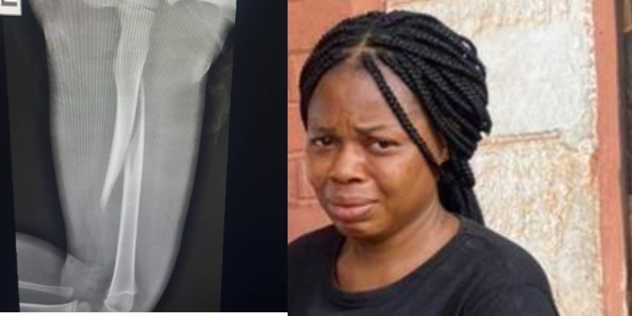 Enugu woman remanded for allegedly breaking stepson’s leg with pestle