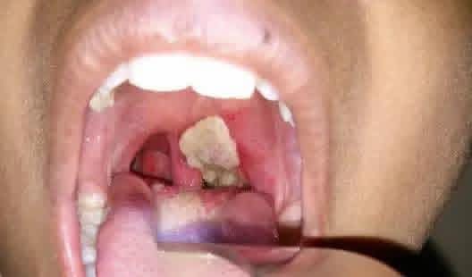 FG Activates Emergency Task Force as Diphtheria Outbreak Hits Katsina, Kano